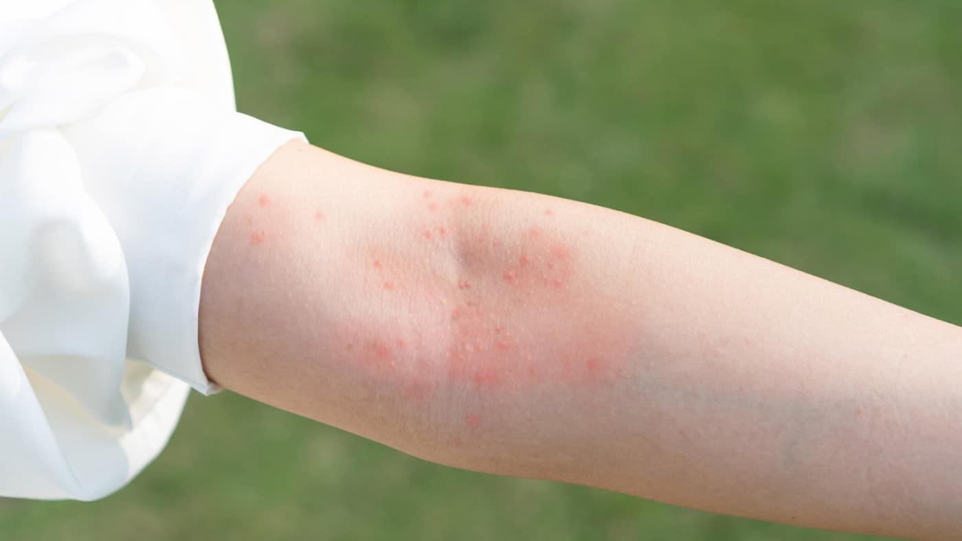 Skin Allergies: Symptoms, Causes, Testing, & Treatments